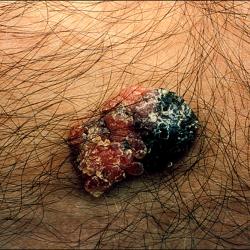 Example of skinLumpsAndBumps
